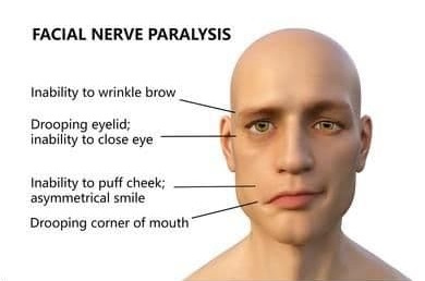 Facial Paralysis Therapy